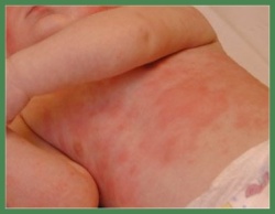 Clay is a natural remedy for psorasis and eczema