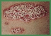 Using clay as a natural remedy for psoriasis and eczema