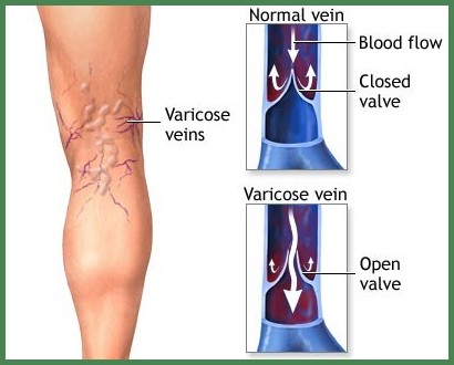 Using bentonite clay to remove spider veins and varicose veins