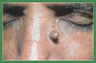 Bentonite Clay for natural easy painless wart removal