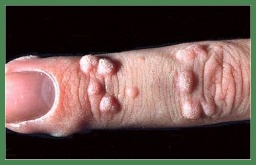 Bentonite Clay for natural easy painless wart removal