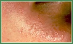 Bentonite Clay for natural easy painless wart removal