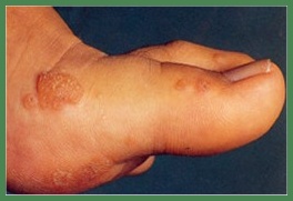 Bentonite Clay for natural easy painless wart removal
